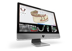 3D implant placement design on computer